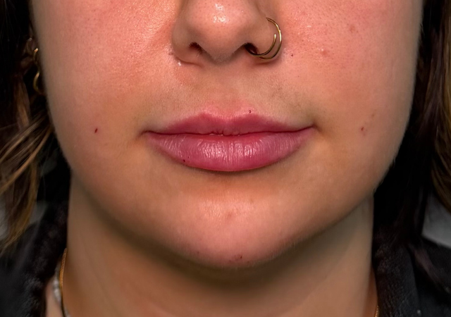 Lips, chin and smile folds, after treatment, selected work by Bissma Ayaz, RN