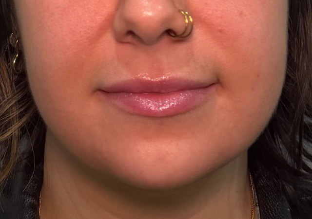 Lips, chin and smile folds, before treatment, selected work by Bissma Ayaz, RN