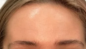 Forehead and frown lines, after treatment, selected work by Bissma Ayaz, RN