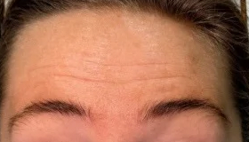Forehead and frown lines, before treatment, selected work by Bissma Ayaz, RN