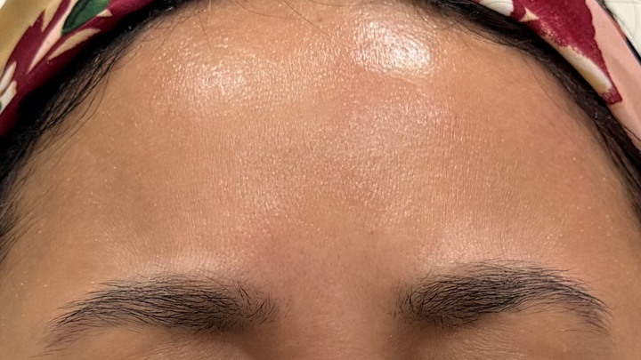 Frown lines, after treatment, selected work by Bissma Ayaz, RN