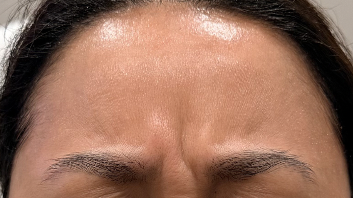 Frown lines, before treatment, selected work by Bissma Ayaz, RN