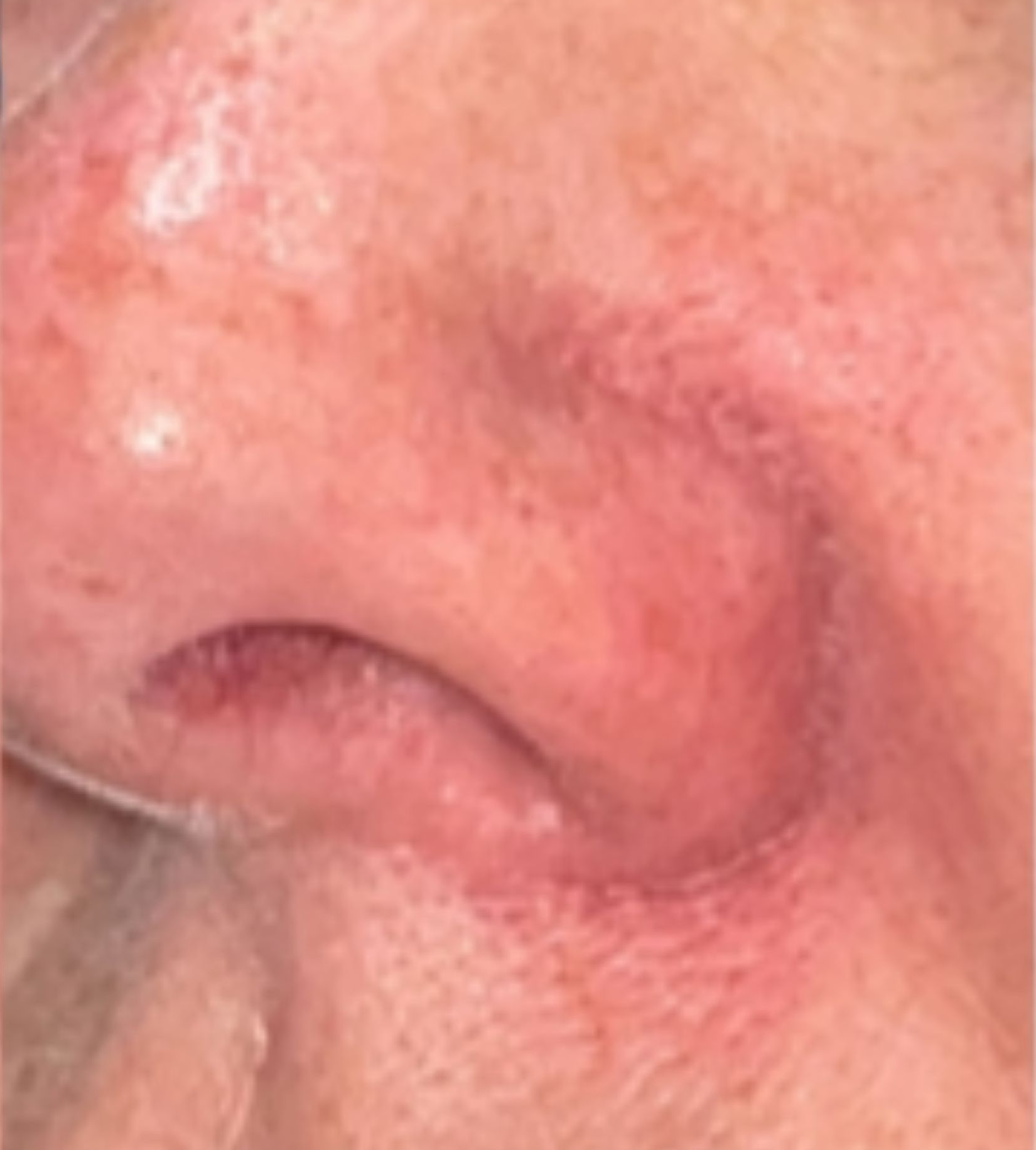 Nose and surrounding skin, after treatment, manufacturer-supplied laser and light example