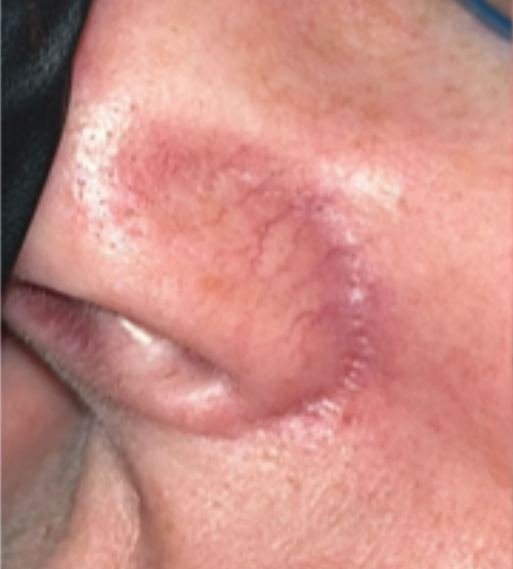 Nose and surrounding skin, before treatment, manufacturer-supplied laser and light example