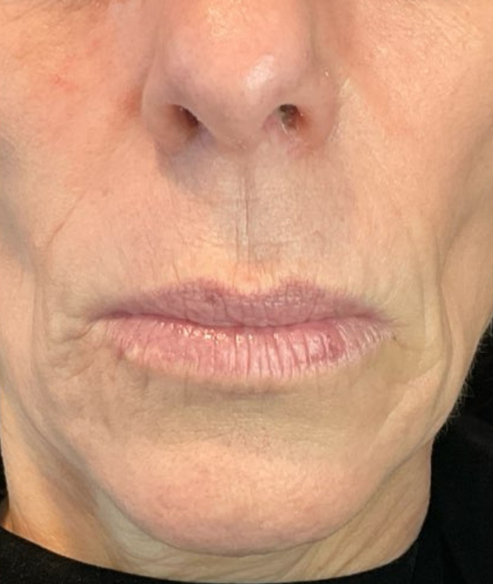 Lower face, after treatment, manufacturer-supplied laser and light example
