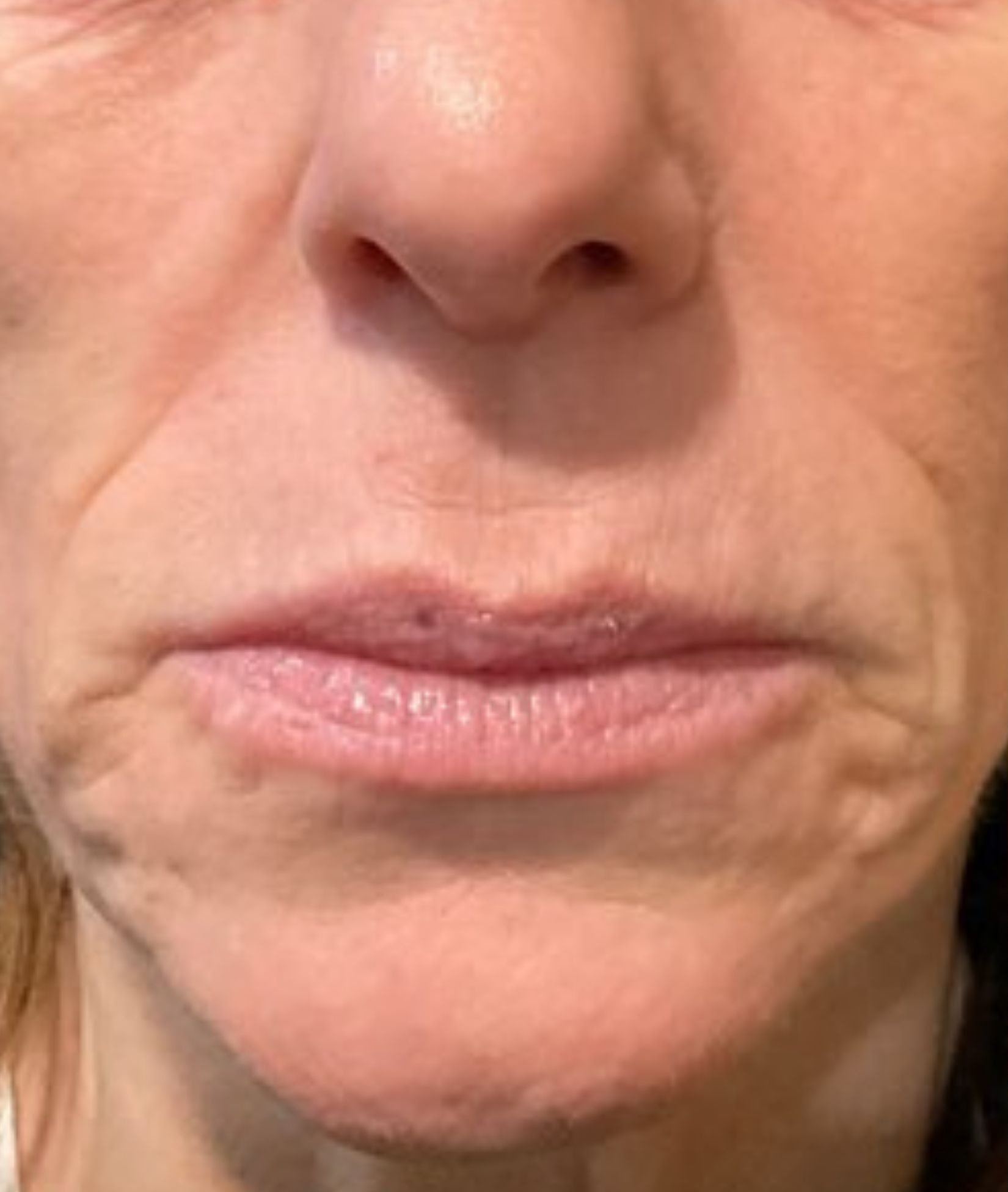 Lower face, before treatment, manufacturer-supplied laser and light example