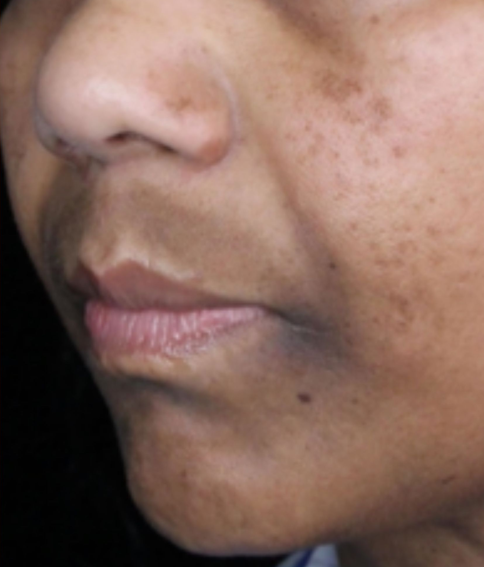 Cheek and lower face, after treatment, manufacturer-supplied laser and light example