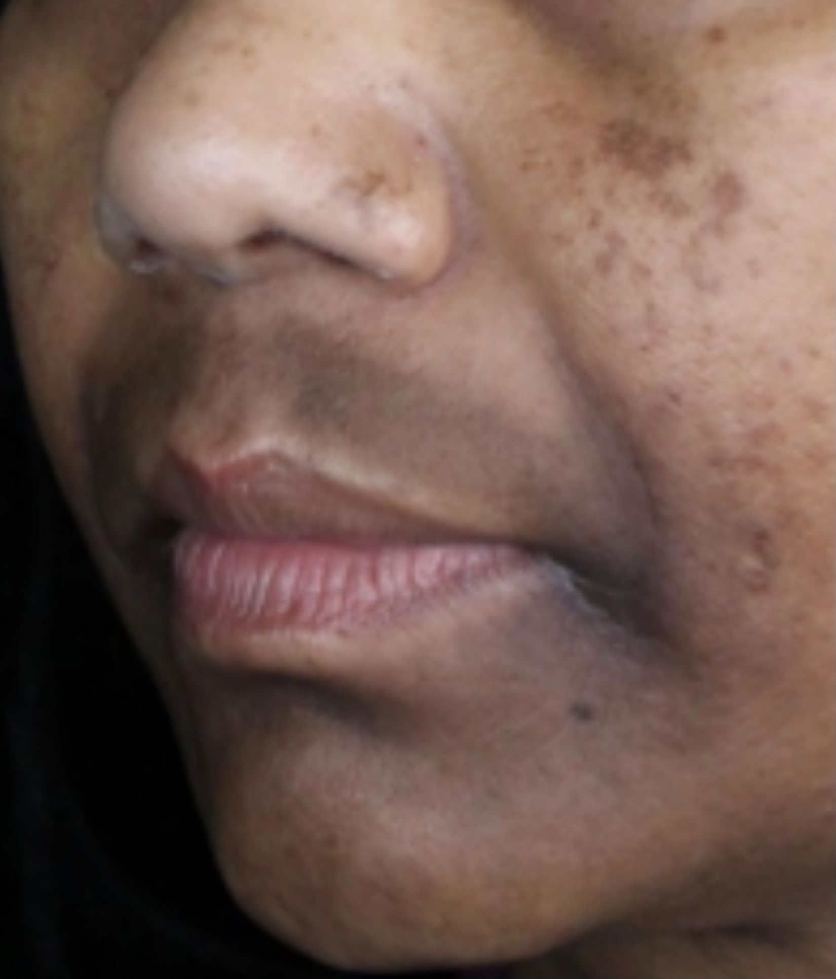 Cheek and lower face, before treatment, manufacturer-supplied laser and light example