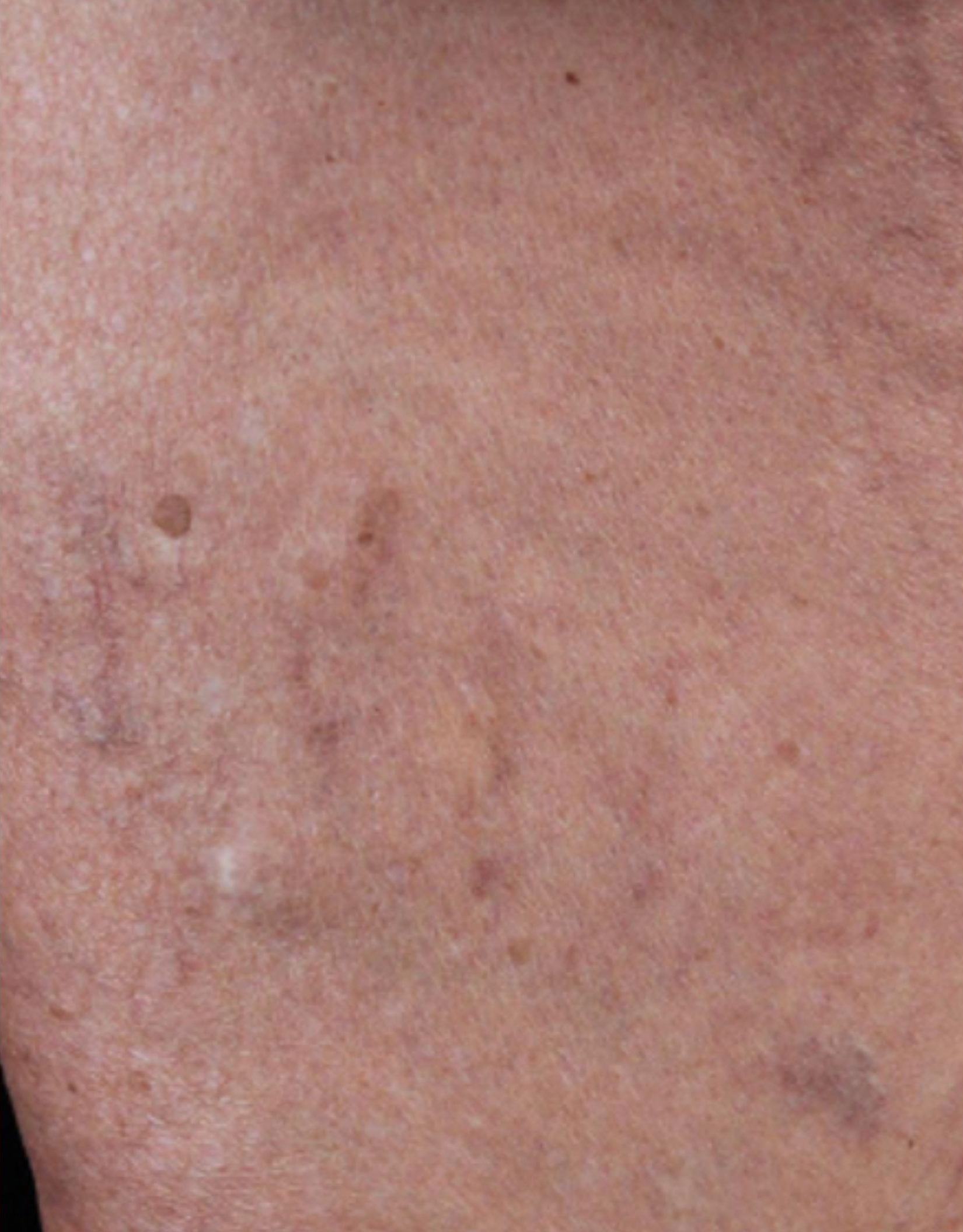 Skin detail, after treatment, manufacturer-supplied laser and light example