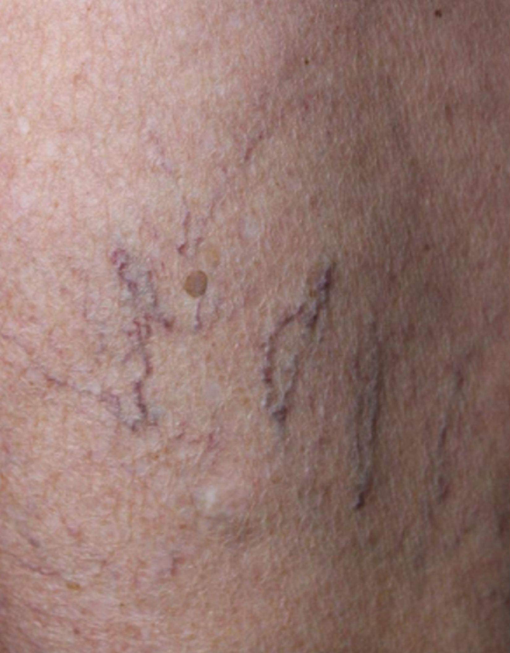 Skin detail, before treatment, manufacturer-supplied laser and light example