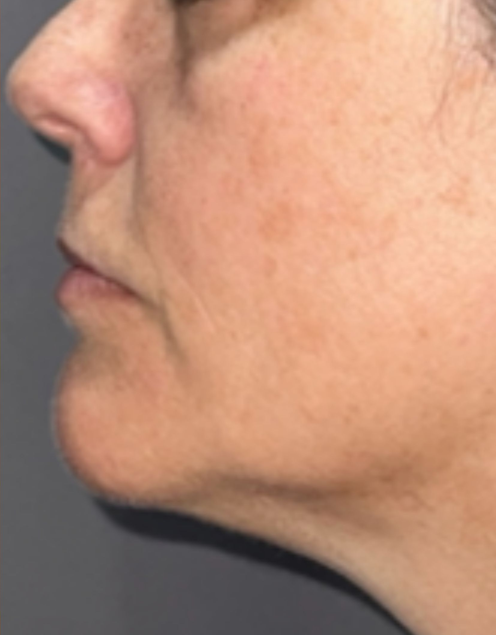 Cheek and jaw profile, after treatment, manufacturer-supplied laser and light example