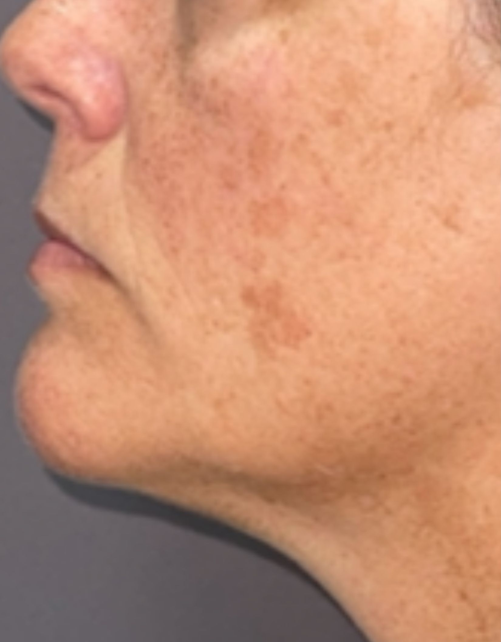 Cheek and jaw profile, before treatment, manufacturer-supplied laser and light example