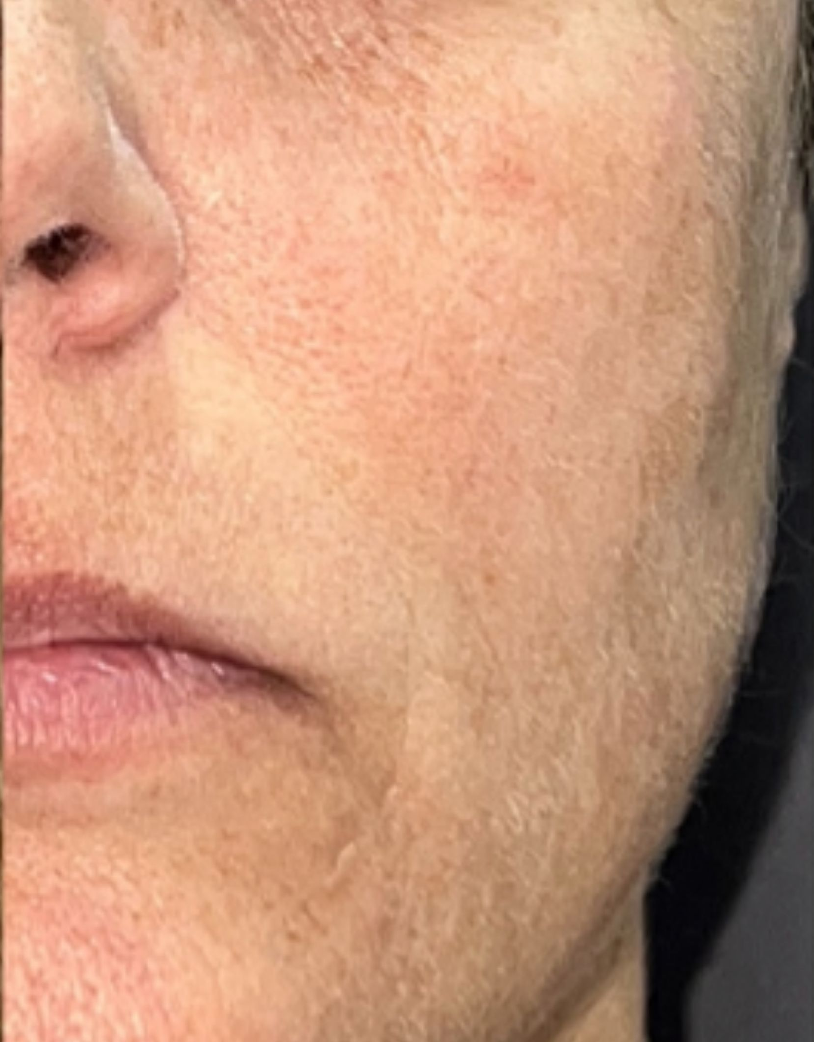 Cheek close-up, after treatment, manufacturer-supplied laser and light example
