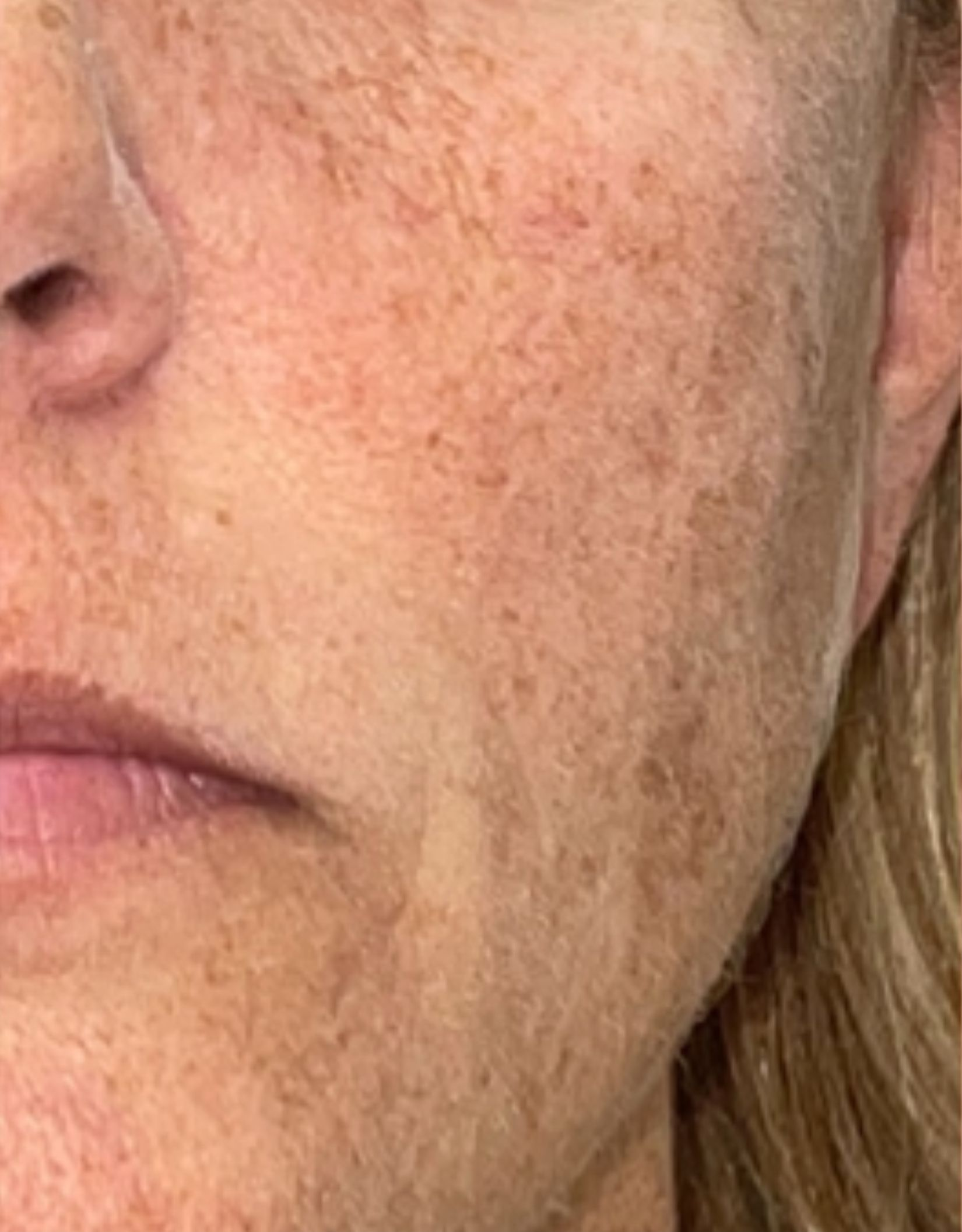 Cheek close-up, before treatment, manufacturer-supplied laser and light example