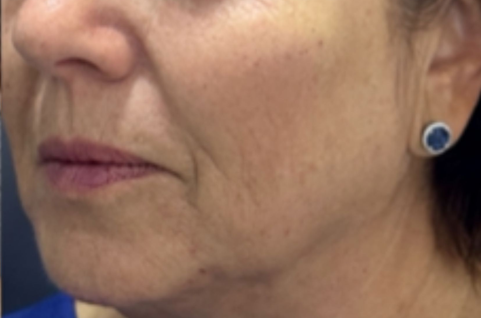 Cheek and lower face, left view, after treatment, manufacturer-supplied laser and light example