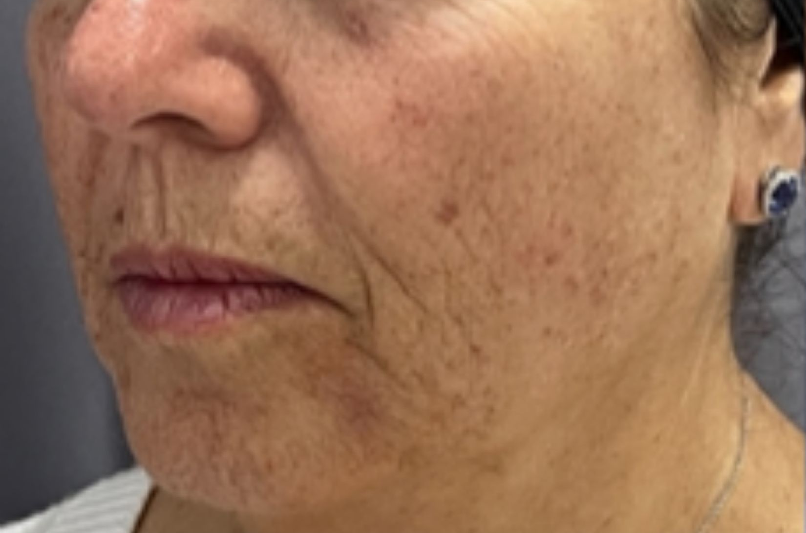 Cheek and lower face, left view, before treatment, manufacturer-supplied laser and light example