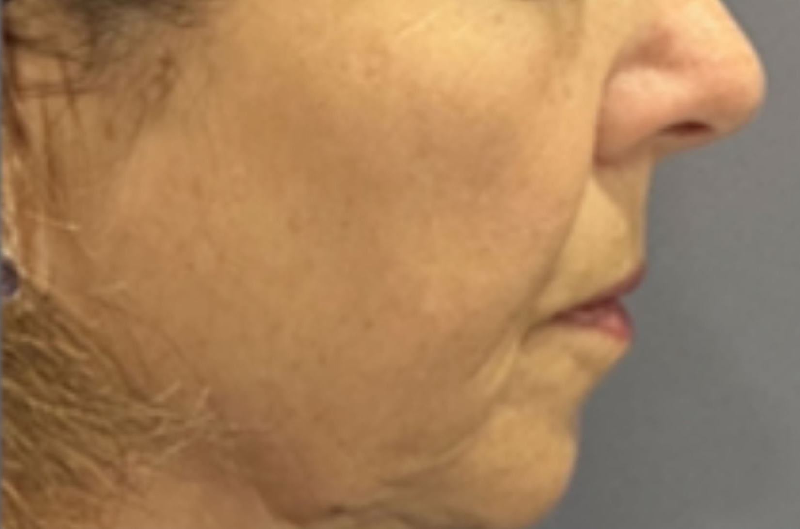 Cheek and lower face, right view, after treatment, manufacturer-supplied laser and light example