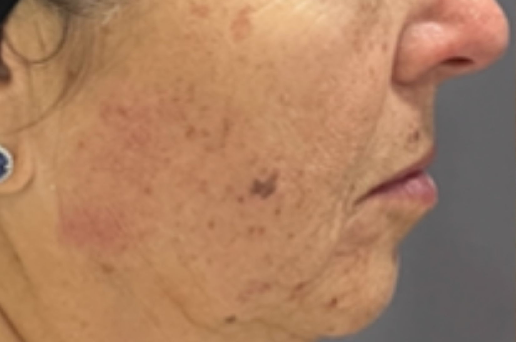Cheek and lower face, right view, before treatment, manufacturer-supplied laser and light example