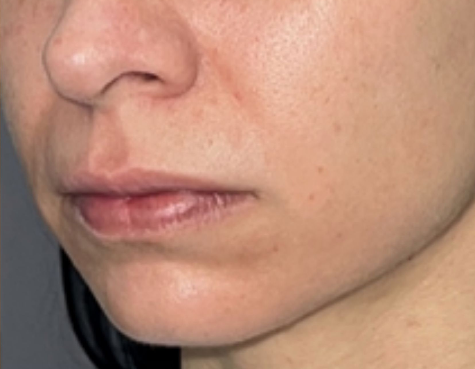 Lower-face close-up, after treatment, manufacturer-supplied laser and light example