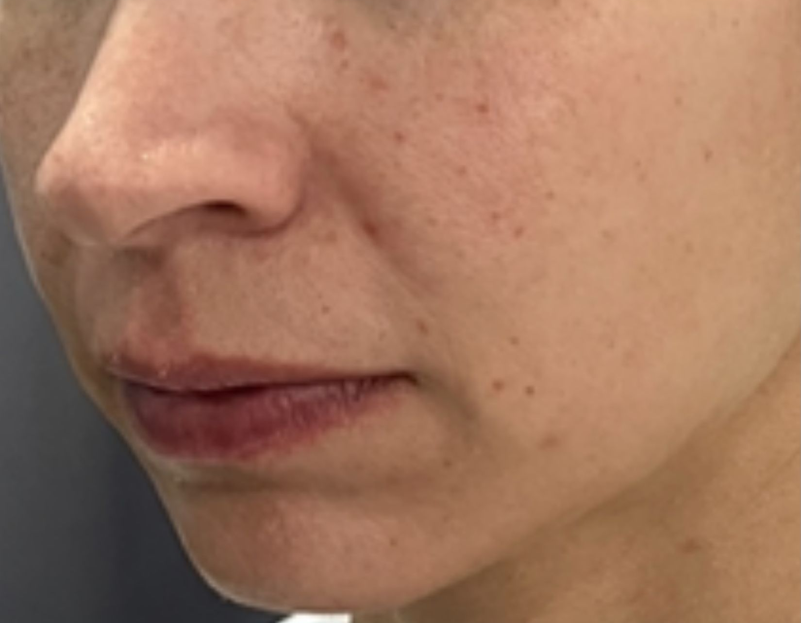 Lower-face close-up, before treatment, manufacturer-supplied laser and light example