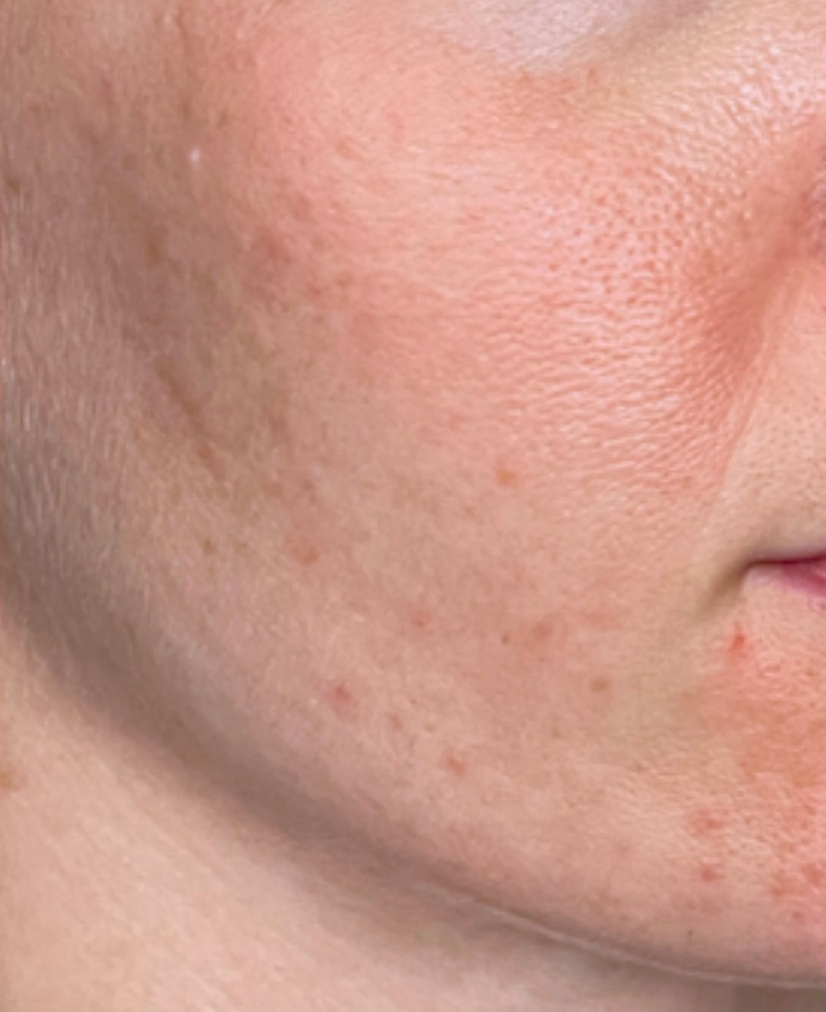 Cheek detail, right view, after treatment, manufacturer-supplied laser and light example