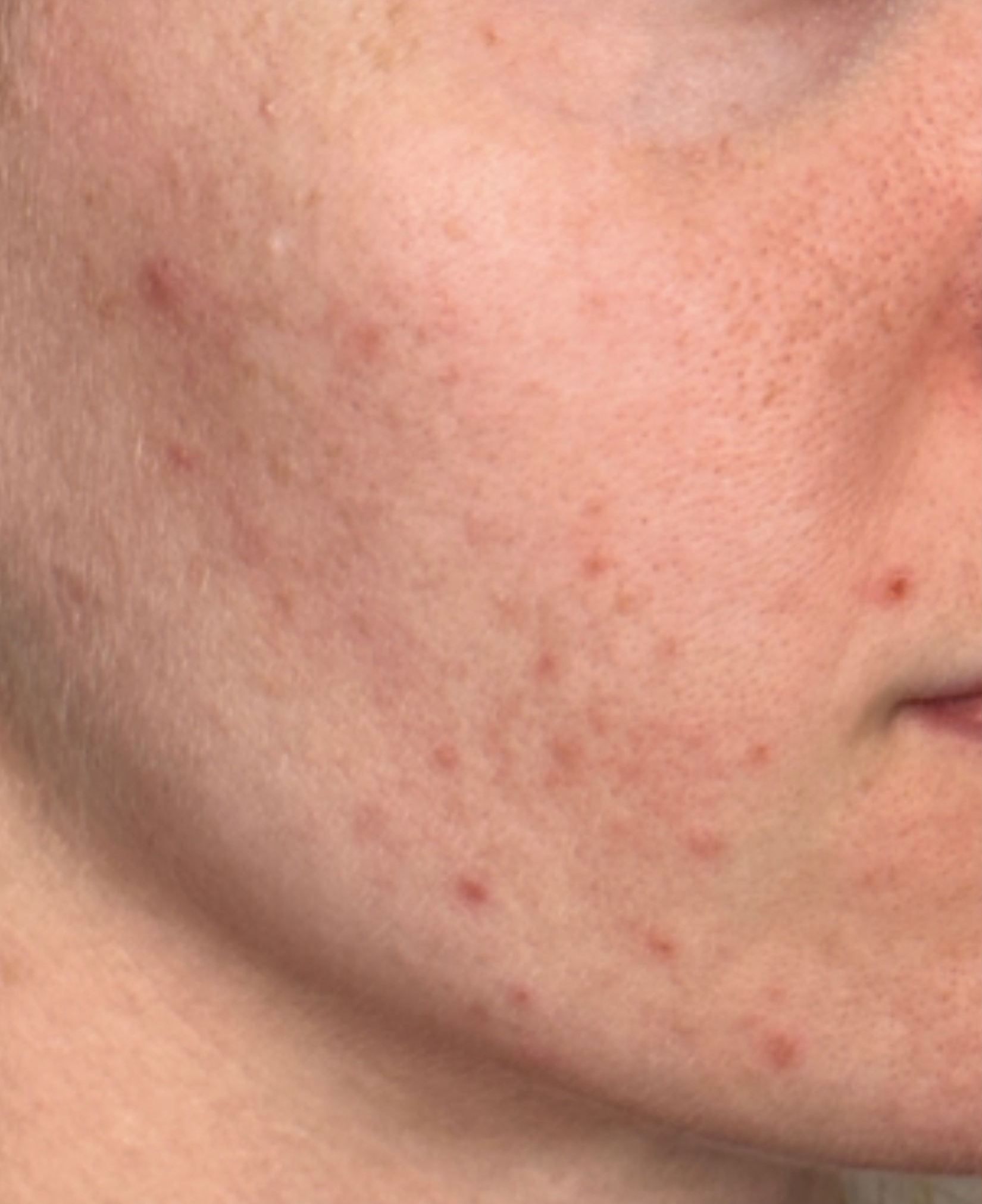 Cheek detail, right view, before treatment, manufacturer-supplied laser and light example