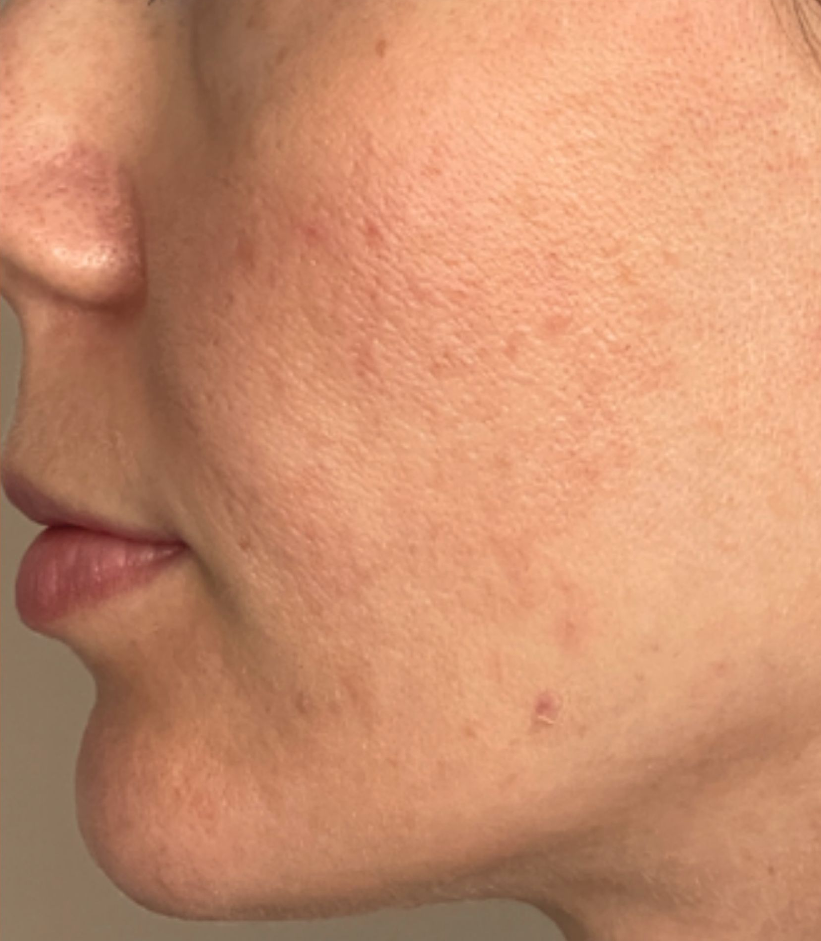 Cheek detail, left view, after treatment, manufacturer-supplied laser and light example