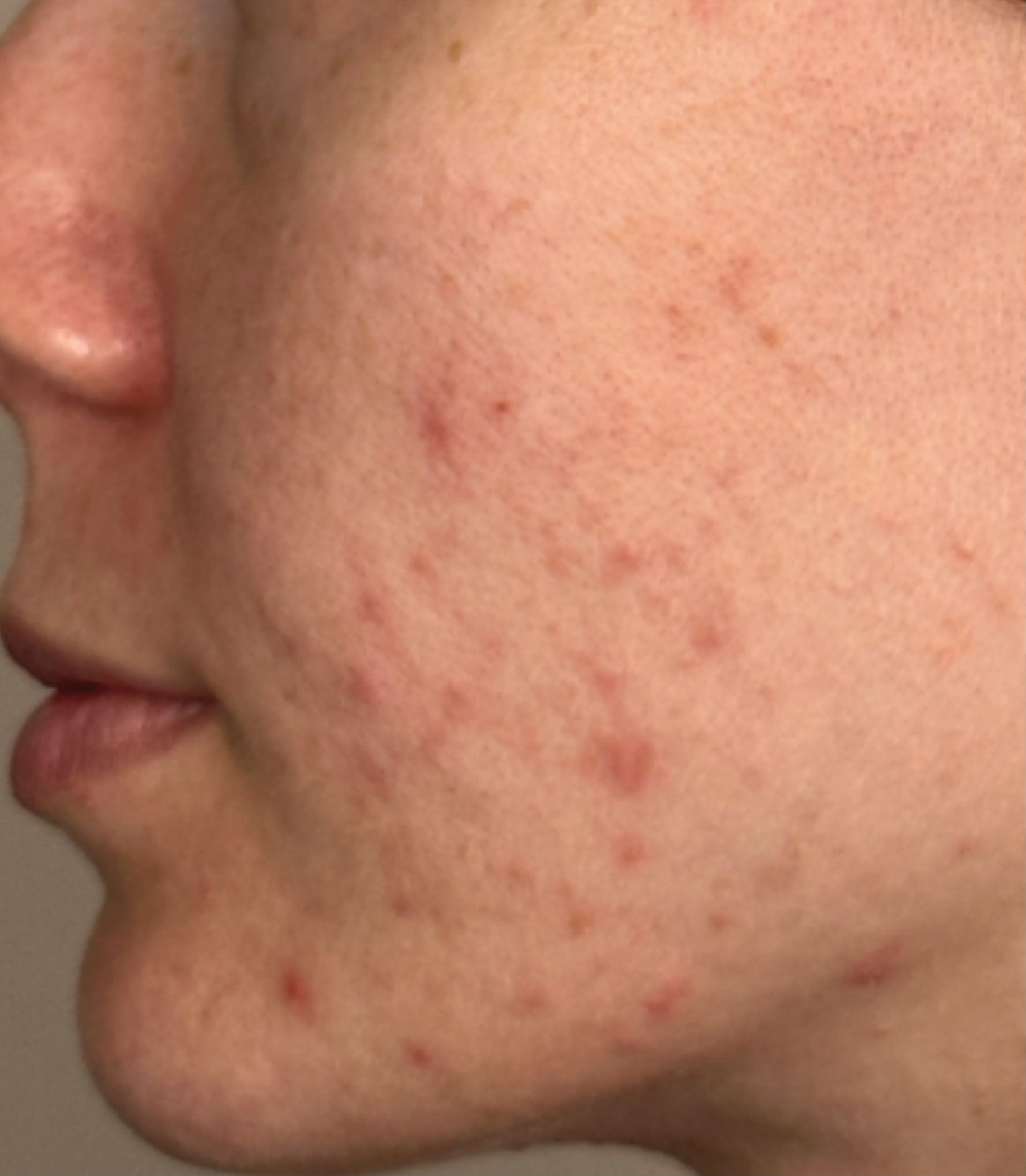 Cheek detail, left view, before treatment, manufacturer-supplied laser and light example