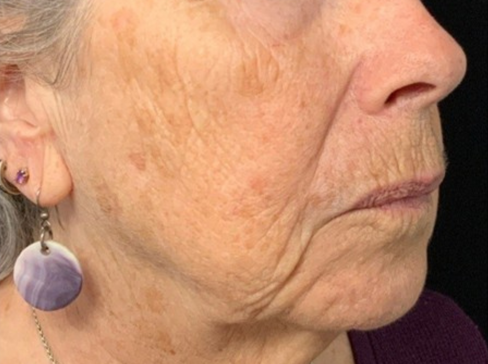 Cheek and jaw, right view, after treatment, manufacturer-supplied laser and light example
