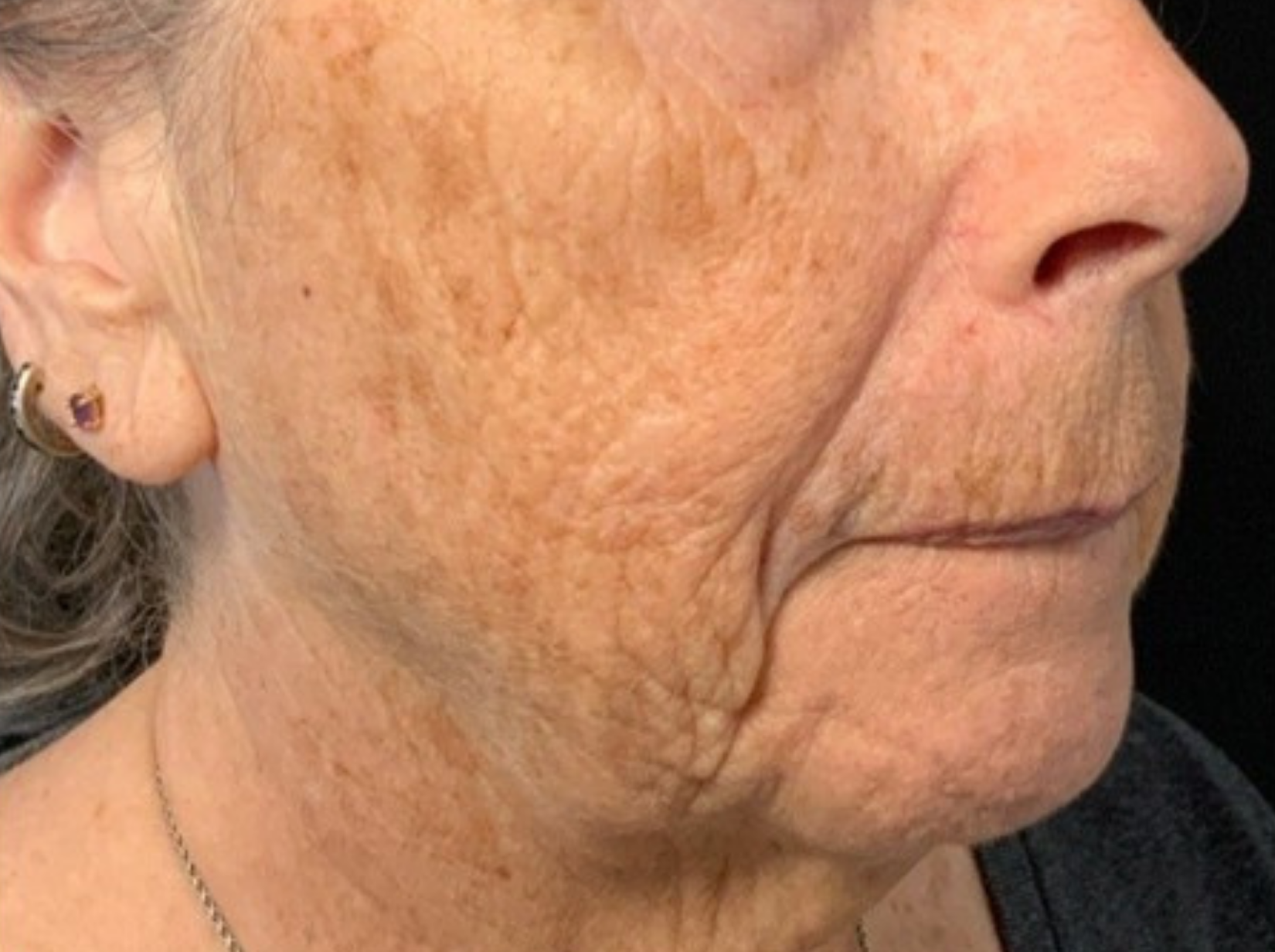 Cheek and jaw, right view, before treatment, manufacturer-supplied laser and light example