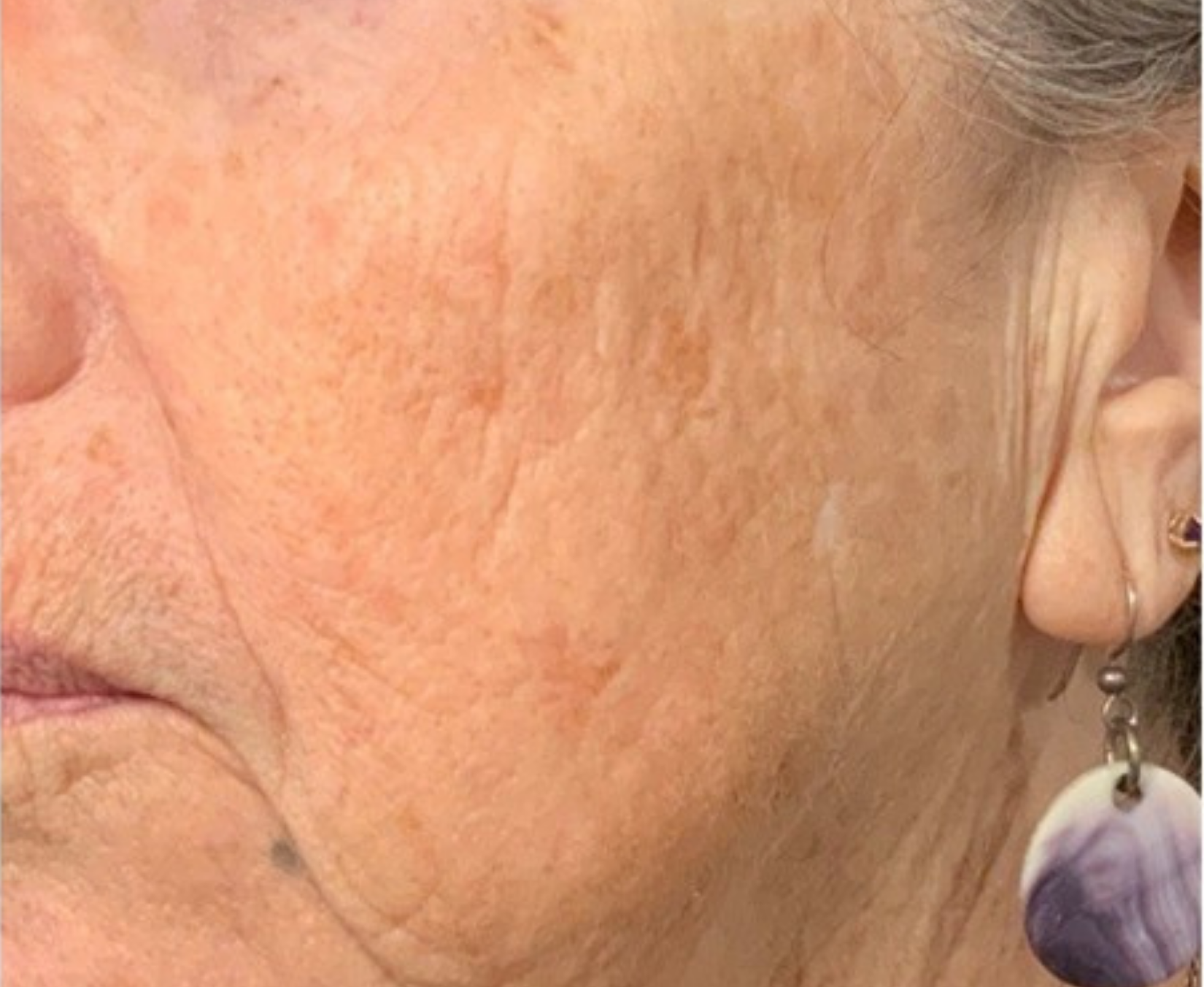 Cheek and jaw, left view, after treatment, manufacturer-supplied laser and light example