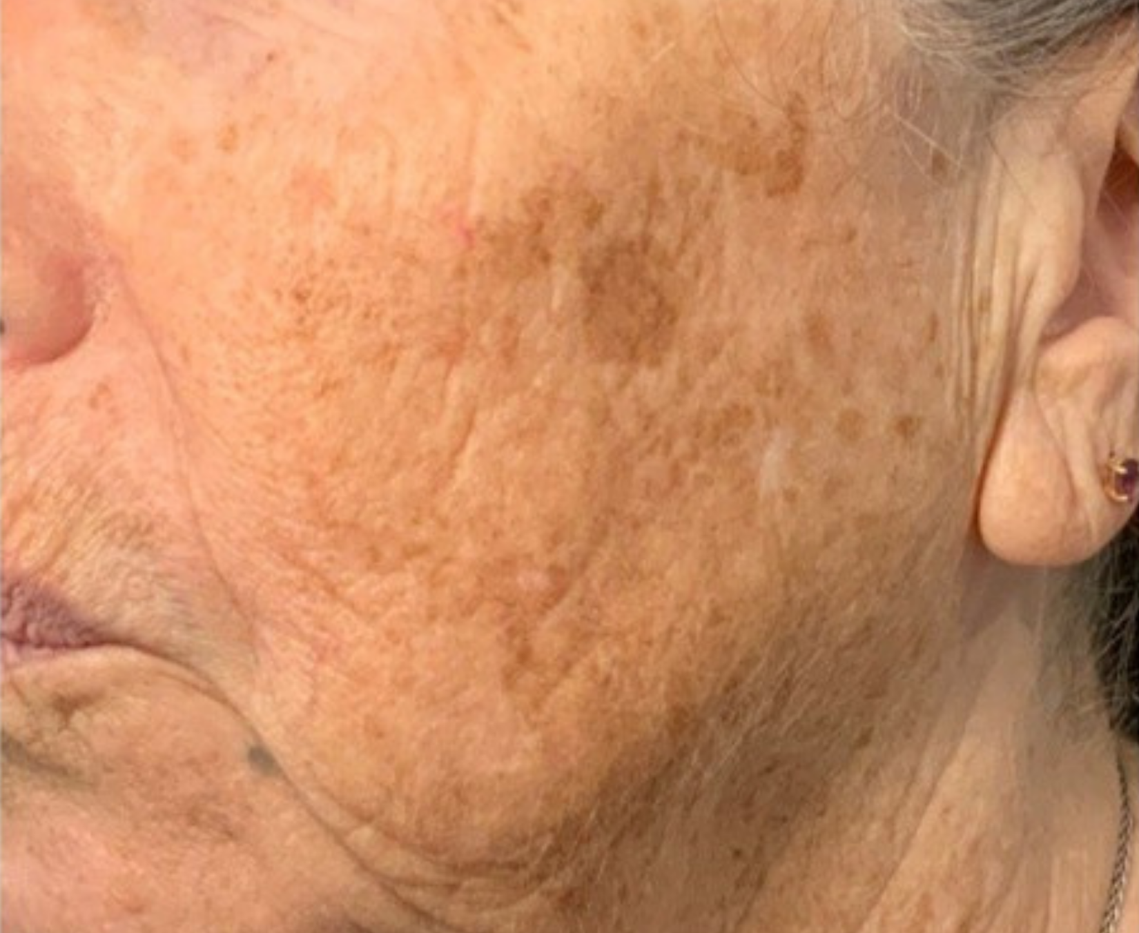 Cheek and jaw, left view, before treatment, manufacturer-supplied laser and light example