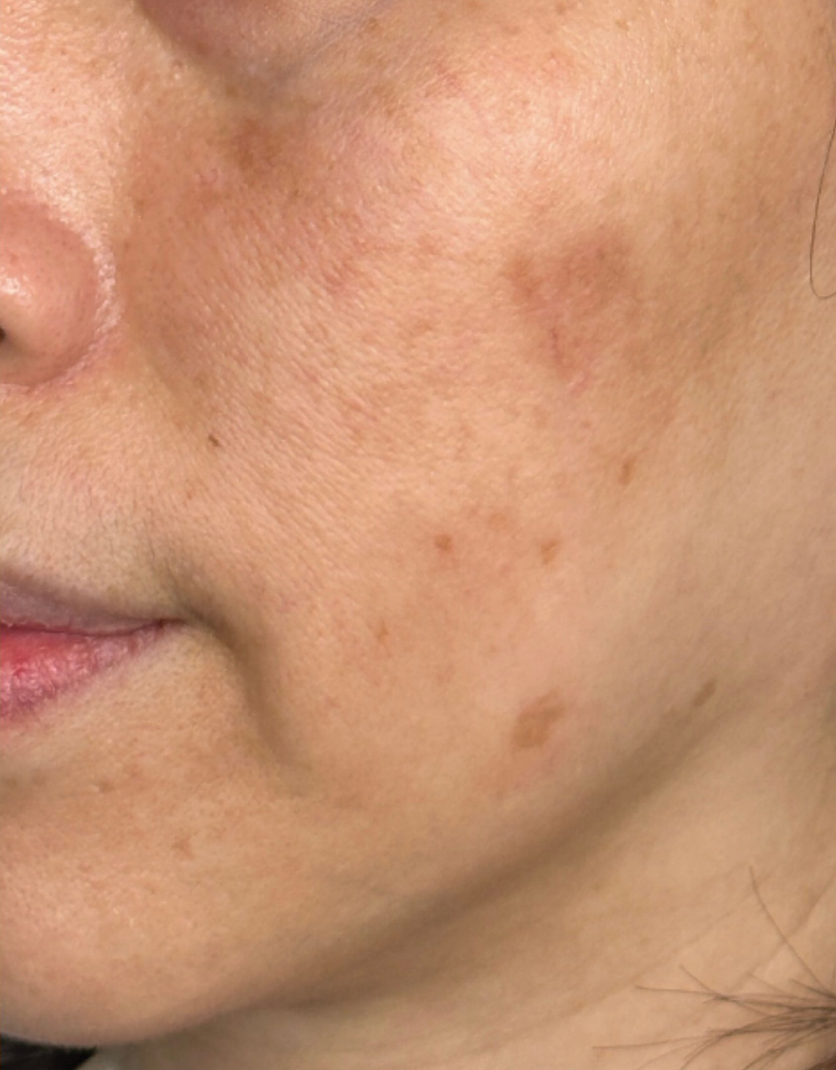 Cheek close-up, left view, after treatment, manufacturer-supplied laser and light example
