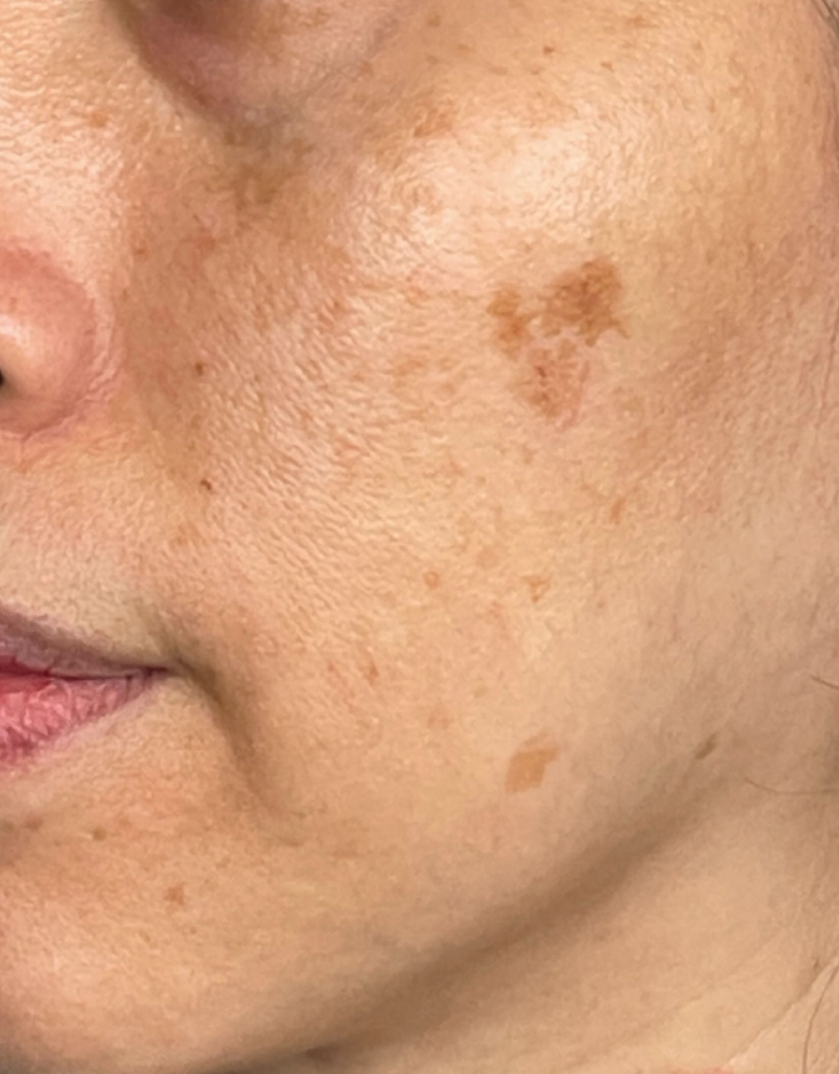 Cheek close-up, left view, before treatment, manufacturer-supplied laser and light example