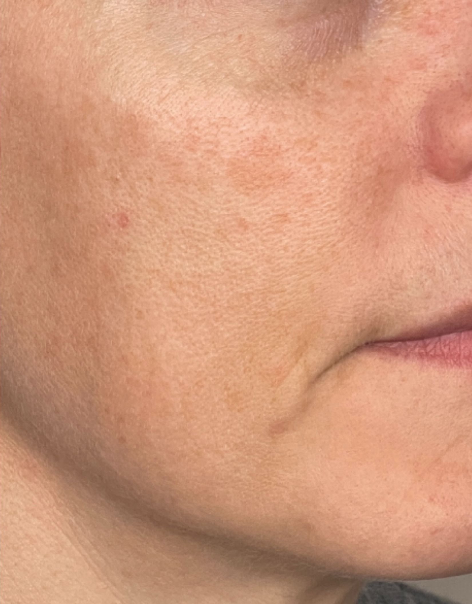 Cheek close-up, right view, after treatment, manufacturer-supplied laser and light example