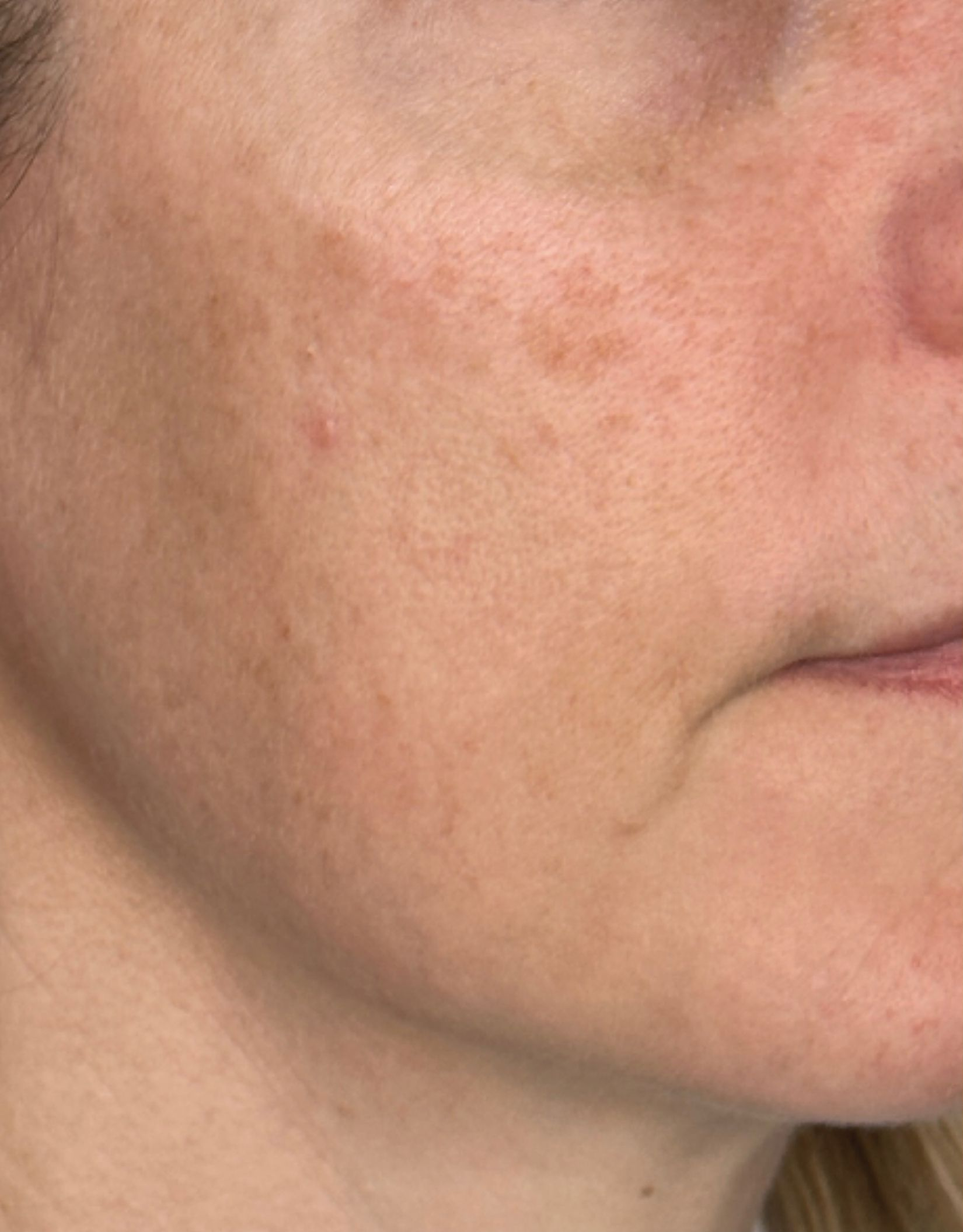 Cheek close-up, right view, before treatment, manufacturer-supplied laser and light example