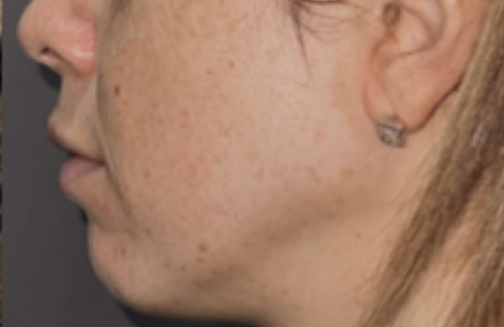 Cheek profile, after treatment, manufacturer-supplied laser and light example