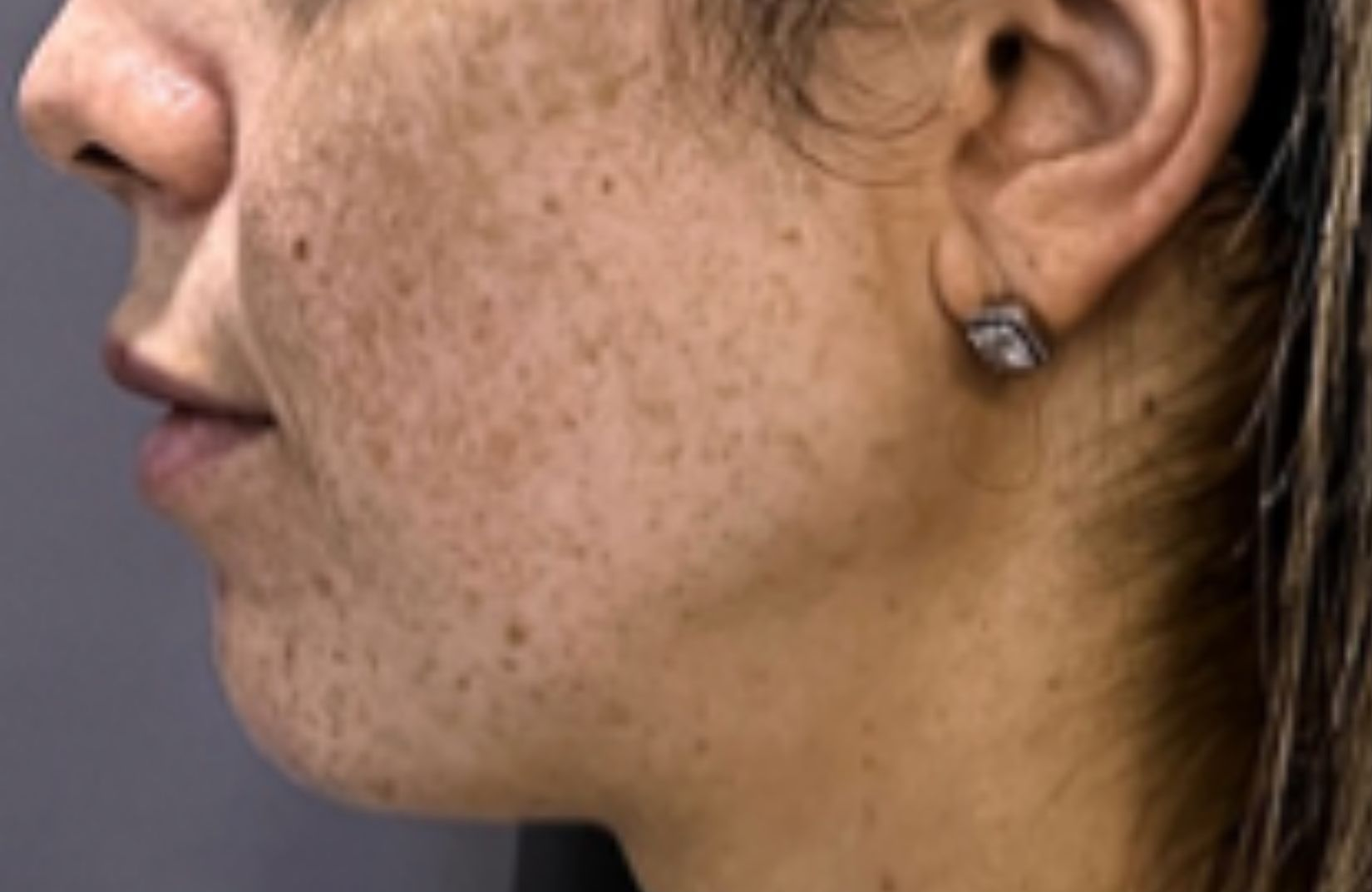 Cheek profile, before treatment, manufacturer-supplied laser and light example