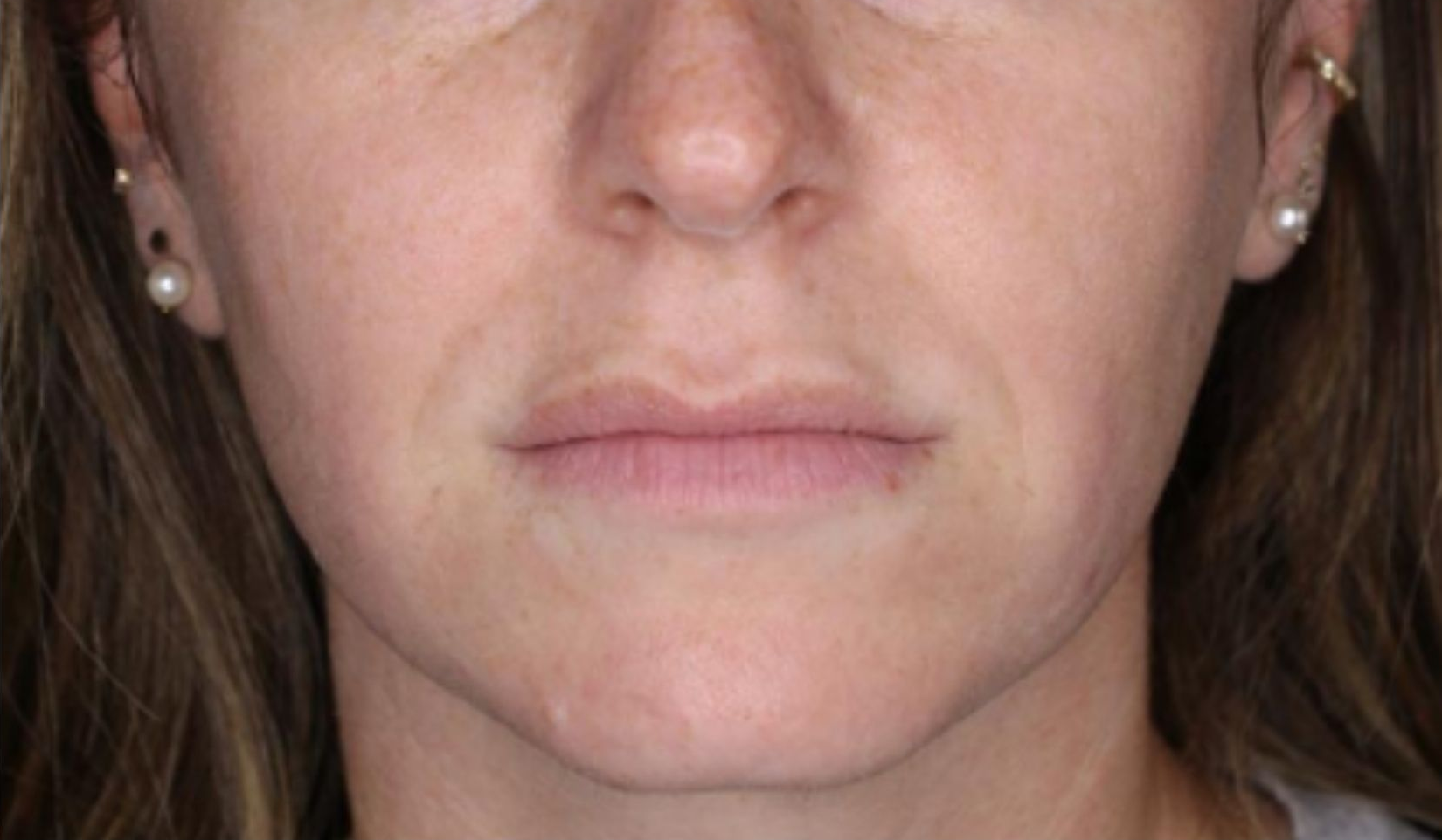 Lower face, front view, after treatment, manufacturer-supplied laser and light example