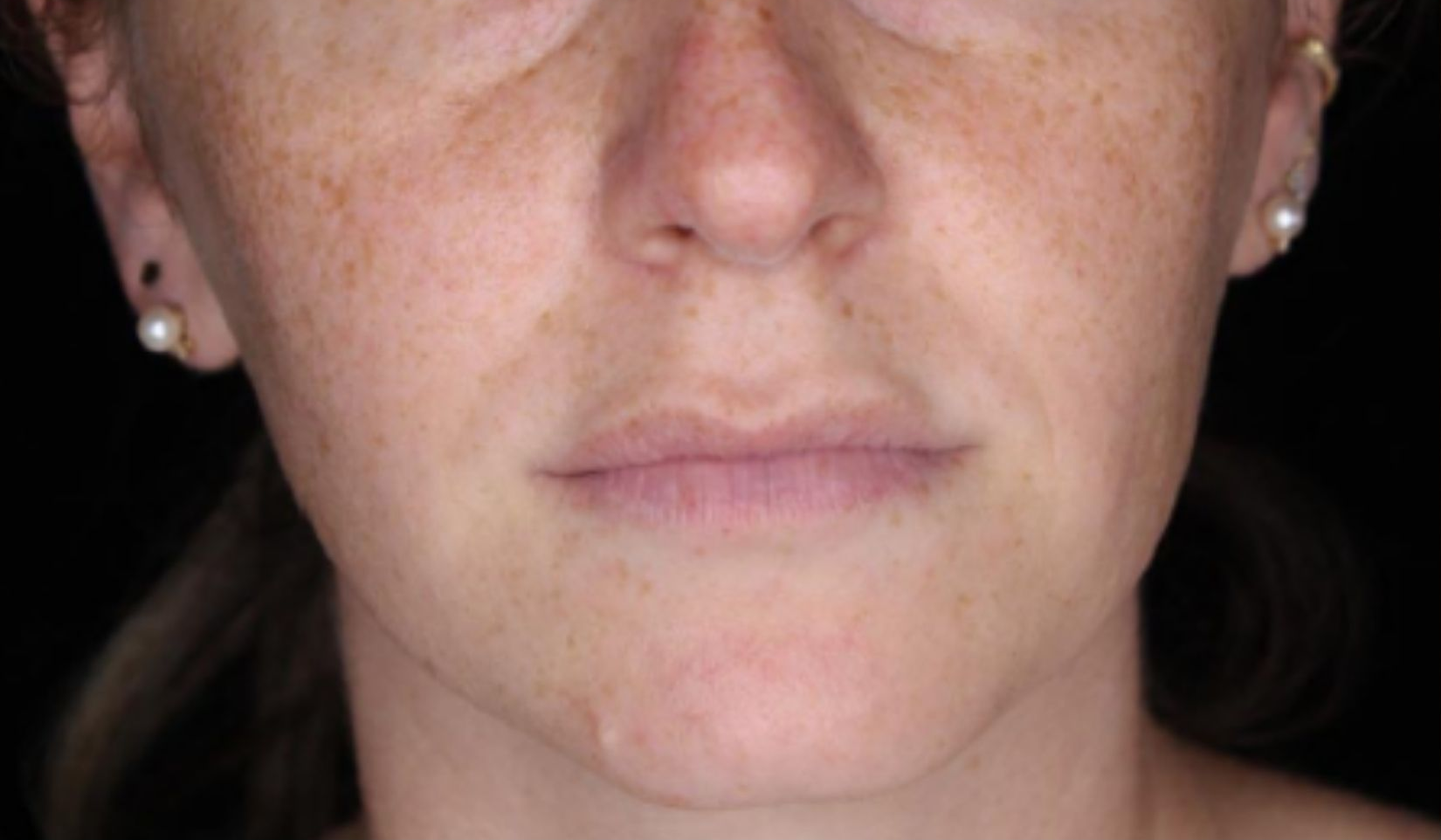Lower face, front view, before treatment, manufacturer-supplied laser and light example