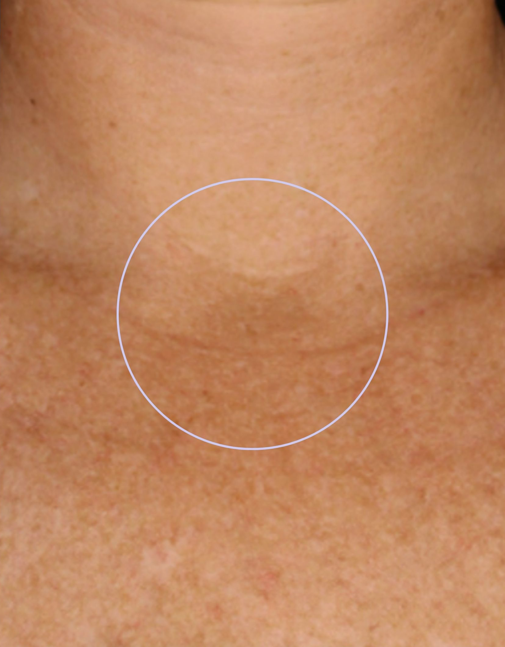 Skin close-up, after treatment, manufacturer-supplied laser and light example