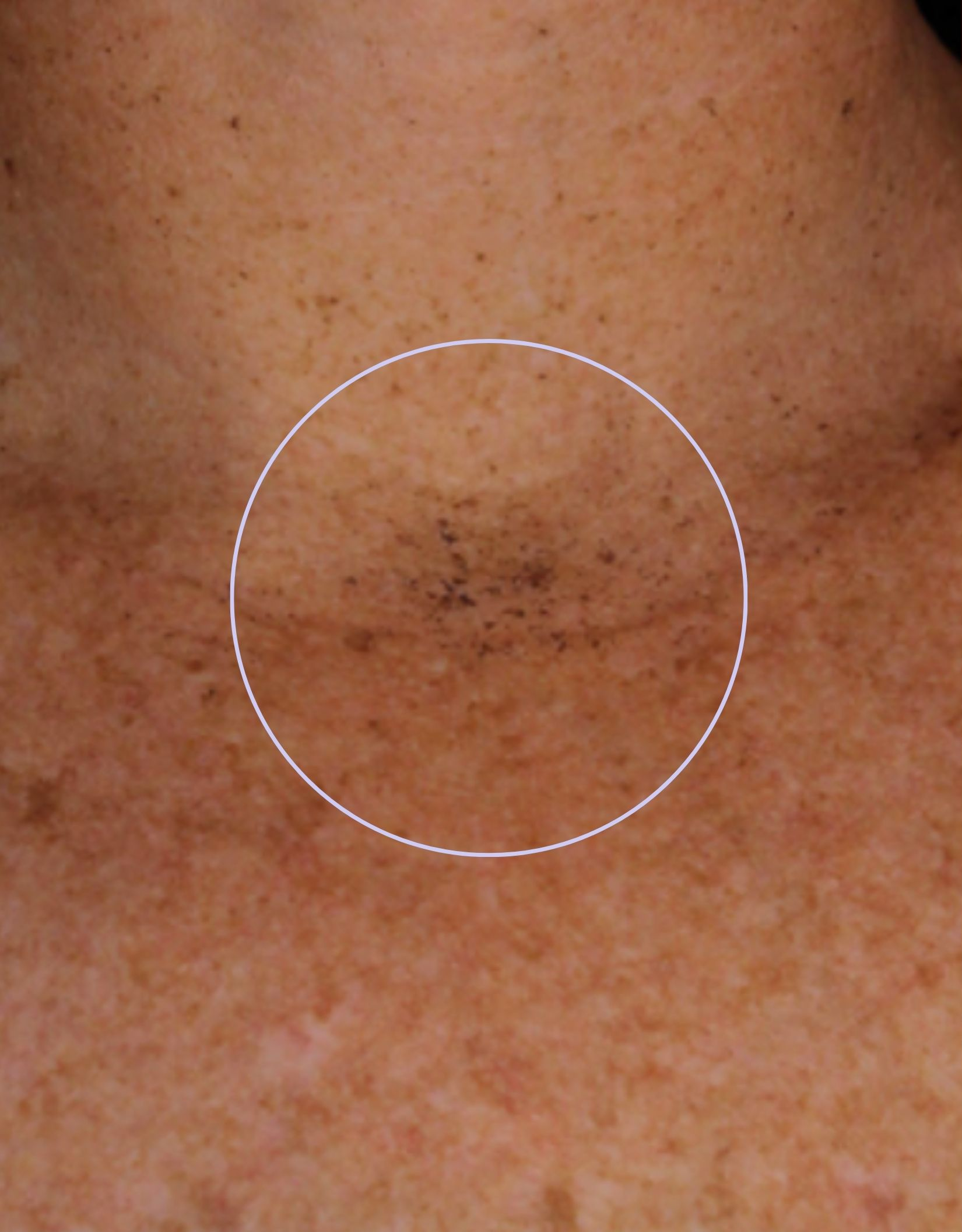 Skin close-up, before treatment, manufacturer-supplied laser and light example