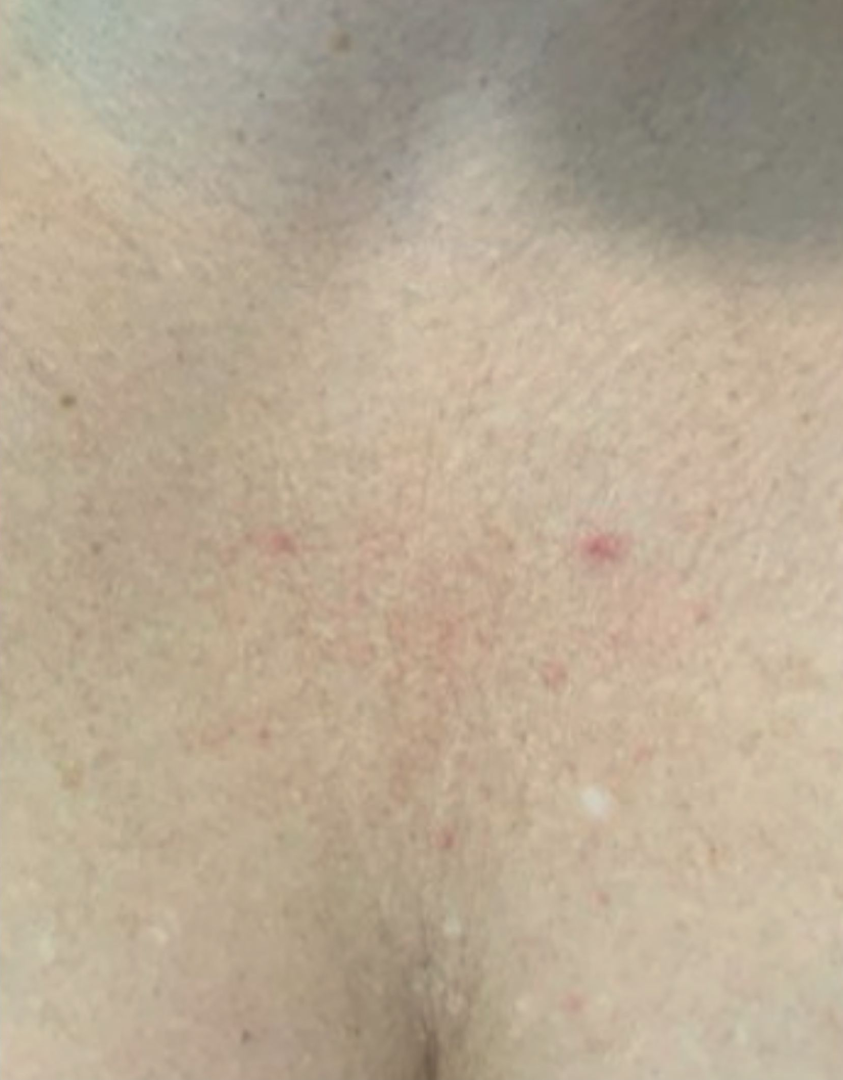 Chest area, example one, after treatment, manufacturer-supplied laser and light example