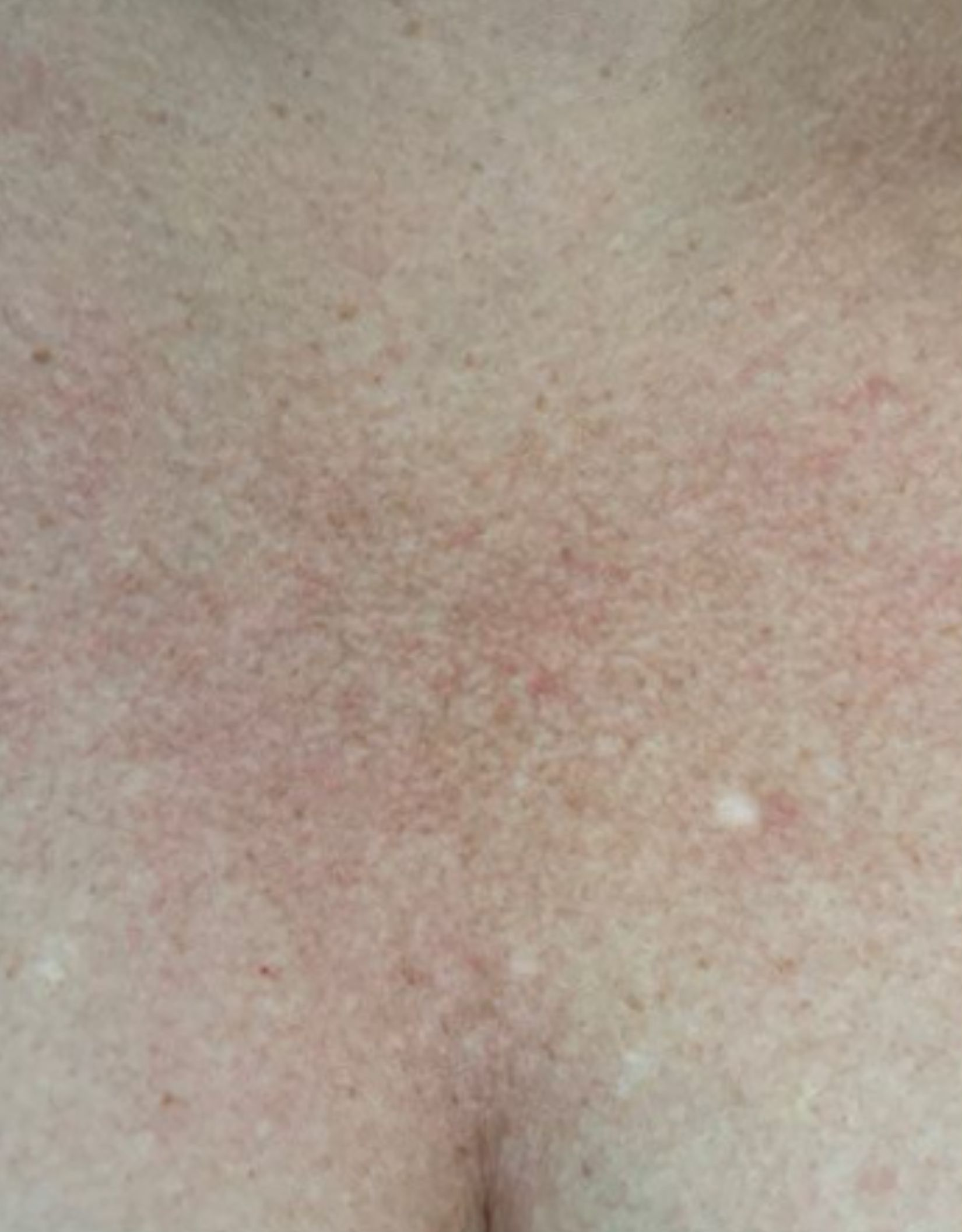 Chest area, example one, before treatment, manufacturer-supplied laser and light example
