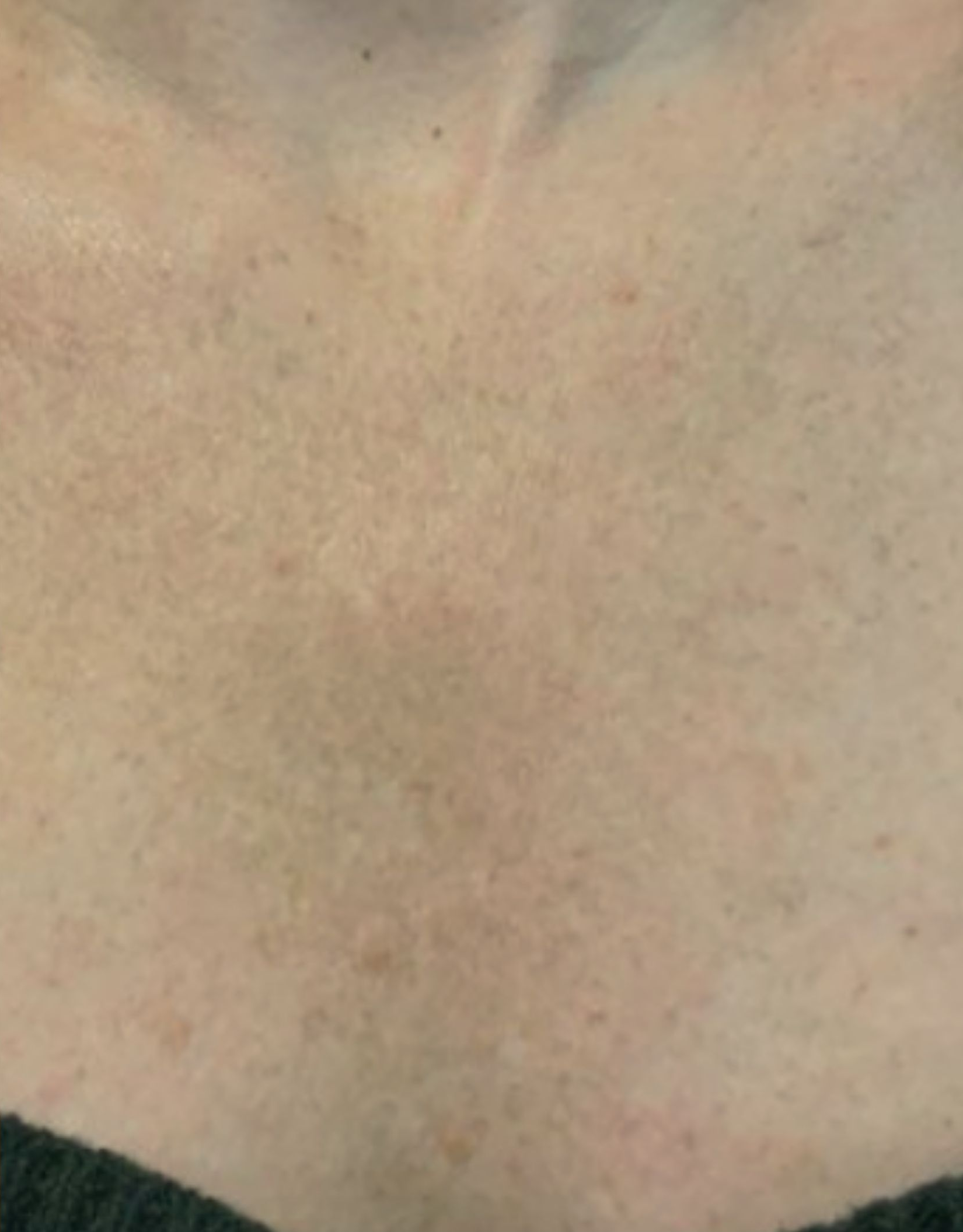 Chest area, example two, after treatment, manufacturer-supplied laser and light example