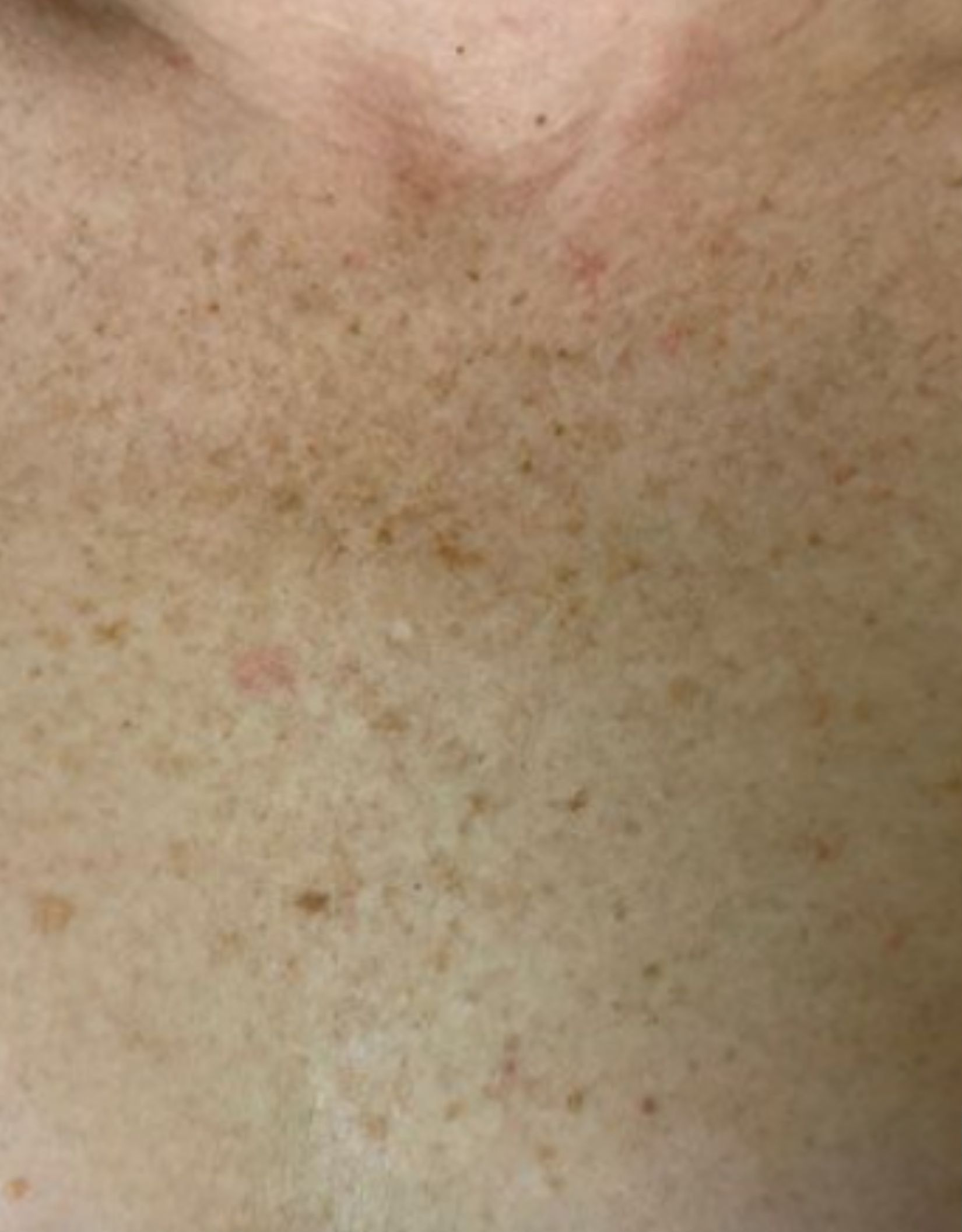 Chest area, example two, before treatment, manufacturer-supplied laser and light example