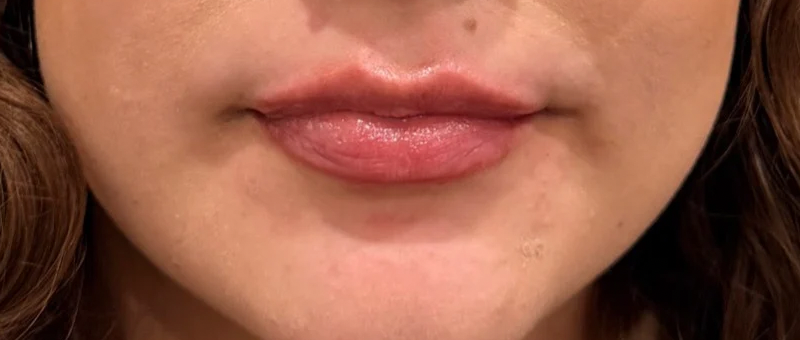 Lip balance, after treatment, selected work by Bissma Ayaz, RN