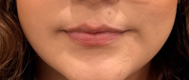 Lip balance, before treatment, selected work by Bissma Ayaz, RN