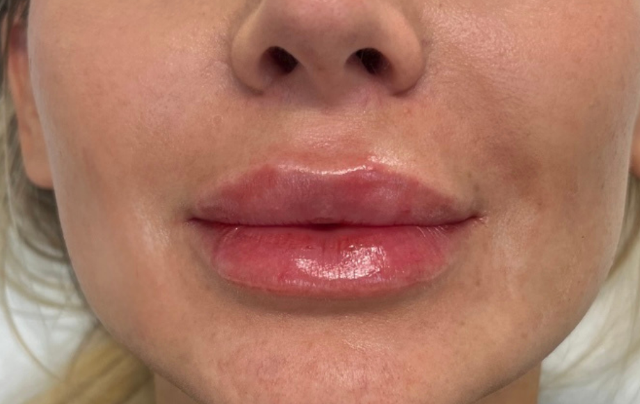Lips and corners, after treatment, selected work by Bissma Ayaz, RN