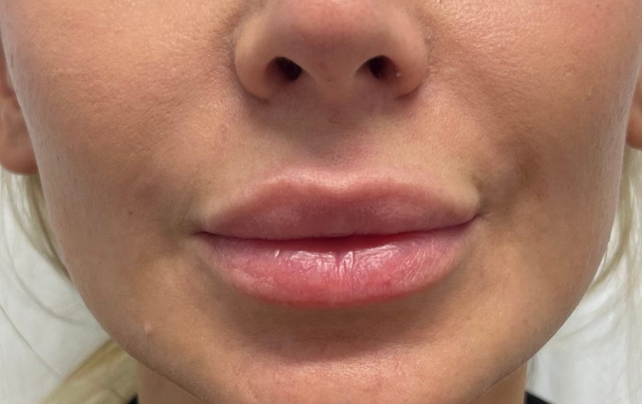 Lips and corners, before treatment, selected work by Bissma Ayaz, RN
